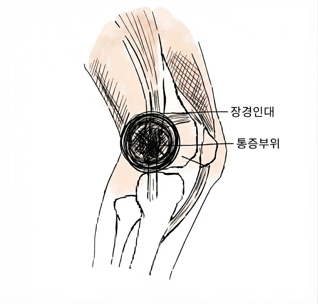 장경인대 증후군